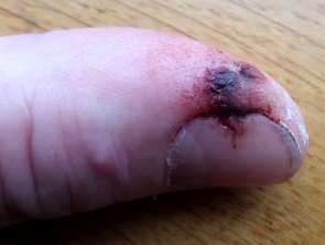 Finger saw cut healed with aloe gel day 1