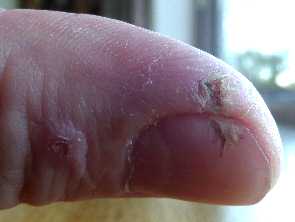 Finger saw cut healed with aloe gel day 18