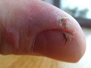 Finger saw cut healed with aloe gel day 21
