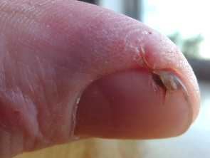 Finger saw cut healed with aloe gel day 24