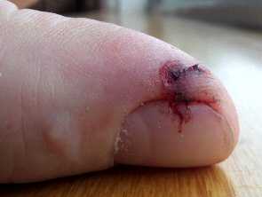 Finger saw cut healed with aloe gel day 2