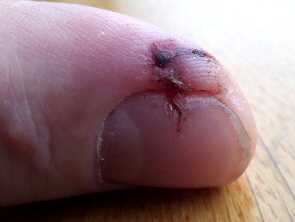 Finger saw cut healed with aloe gel day 4