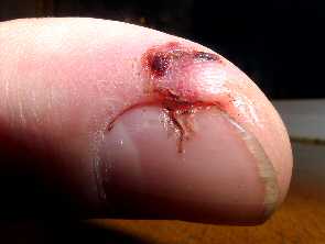 Finger saw cut healed with aloe gel day 9