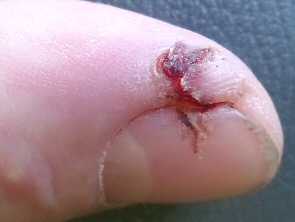 Finger saw cut healed with aloe gel day 11