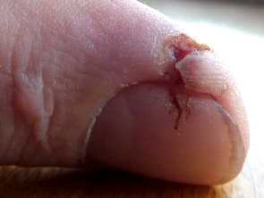 Finger saw cut healed with aloe gel day 13