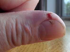 Finger saw cut healed with aloe gel day 15
