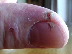 Finger saw cut healed with aloe gel day 16